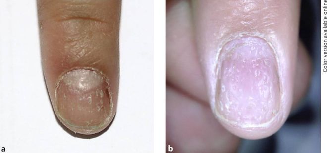 孩子指甲軟薄易斷、月牙少、長白點(diǎn)、豎紋是顯示身體有健康風(fēng)險(xiǎn)嗎？(圖7)