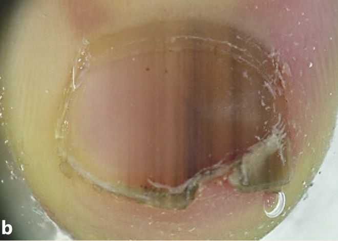 孩子指甲軟薄易斷、月牙少、長白點(diǎn)、豎紋是顯示身體有健康風(fēng)險(xiǎn)嗎？(圖8)