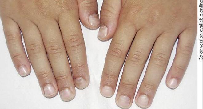 孩子指甲軟薄易斷、月牙少、長白點(diǎn)、豎紋是顯示身體有健康風(fēng)險(xiǎn)嗎？(圖10)