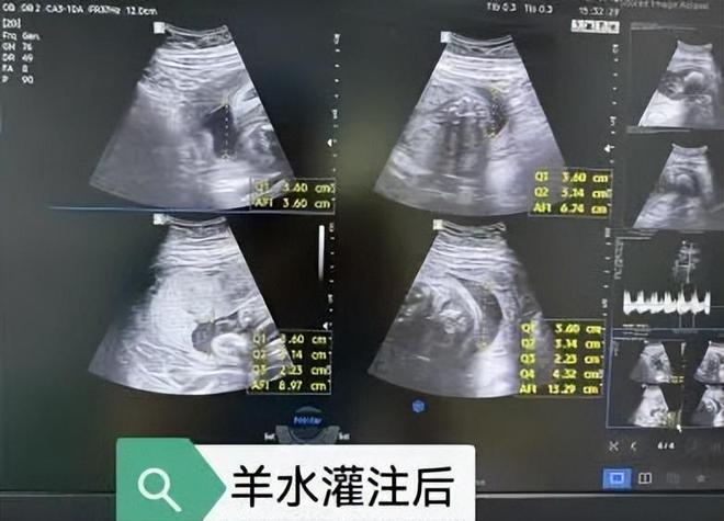 【邯鄲首例】邯鄲市第一醫(yī)院成功實(shí)施胎兒羊水灌注術(shù)(圖3)